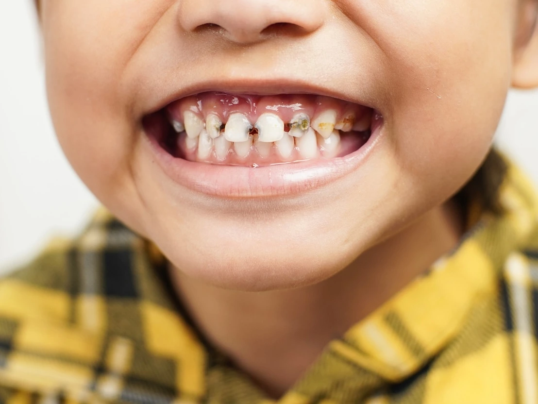 Child receiving a dental exam showing early signs of cavities.
