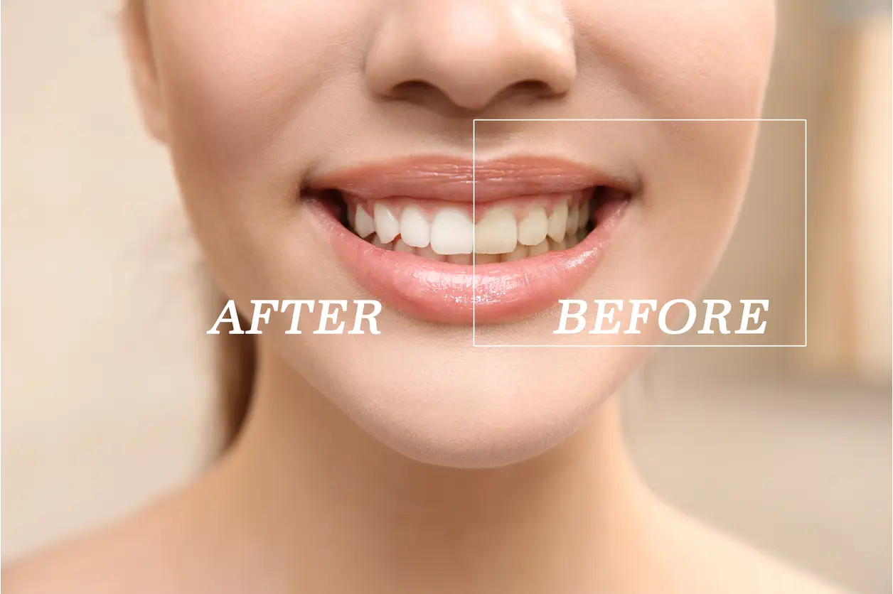 Before and after comparison of professional teeth whitening treatment