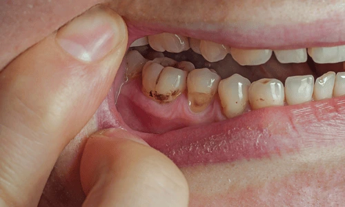 pointing to a tooth with visible cavities and decay