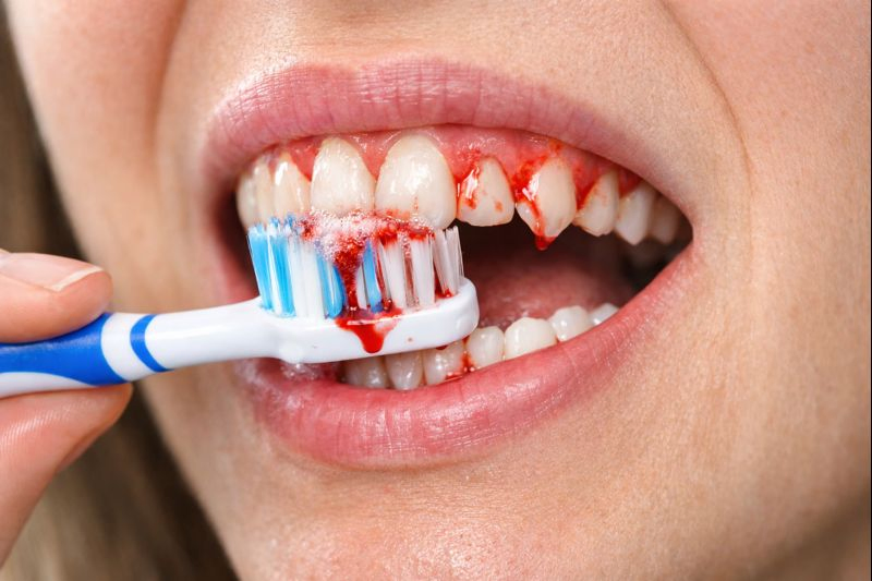 Close-up of a person brushing teeth with slight gum bleeding, showing inflamed red gums and white teeth