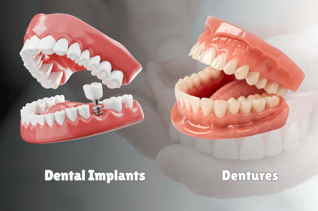 Comparison of dental implants and dentures for long-term tooth replacement.