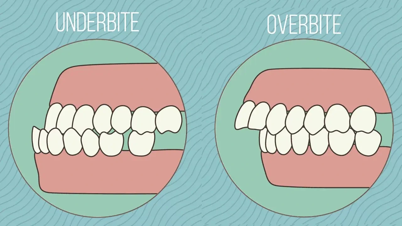 invisalign frequently asked questions