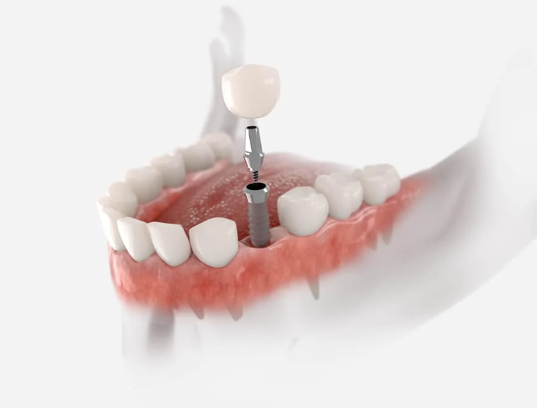 Dental Implants in San Diego