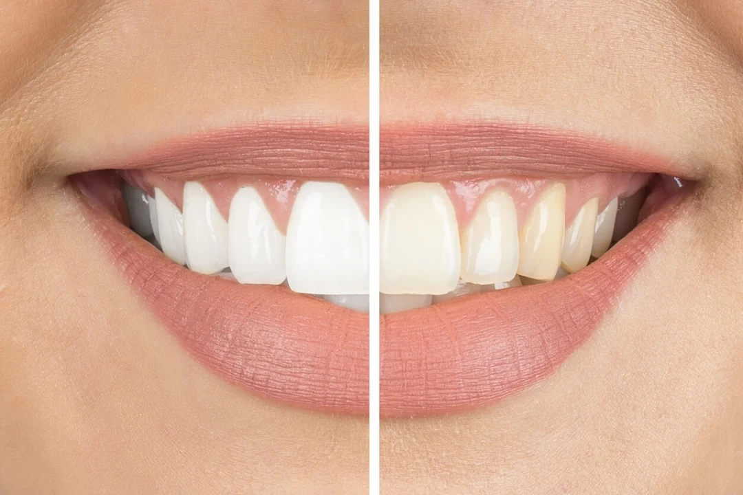 Teeth Whitening in San Diego