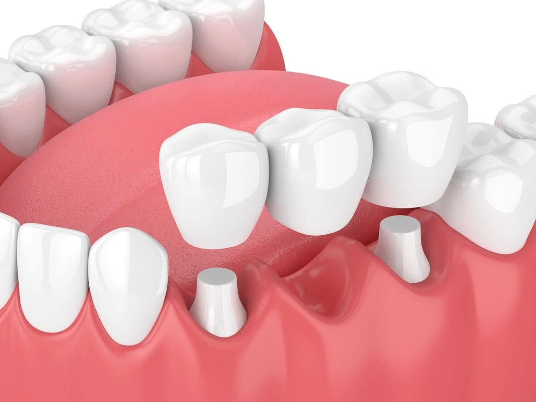 Dental Bridge in San Diego 