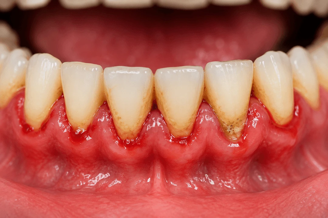 Gum Disease Treatment in San Diego