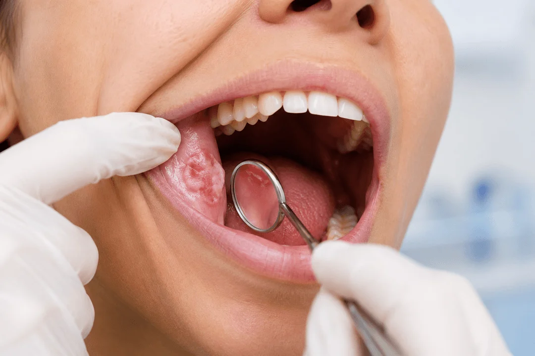 Oral Cancer Screening in San Diego