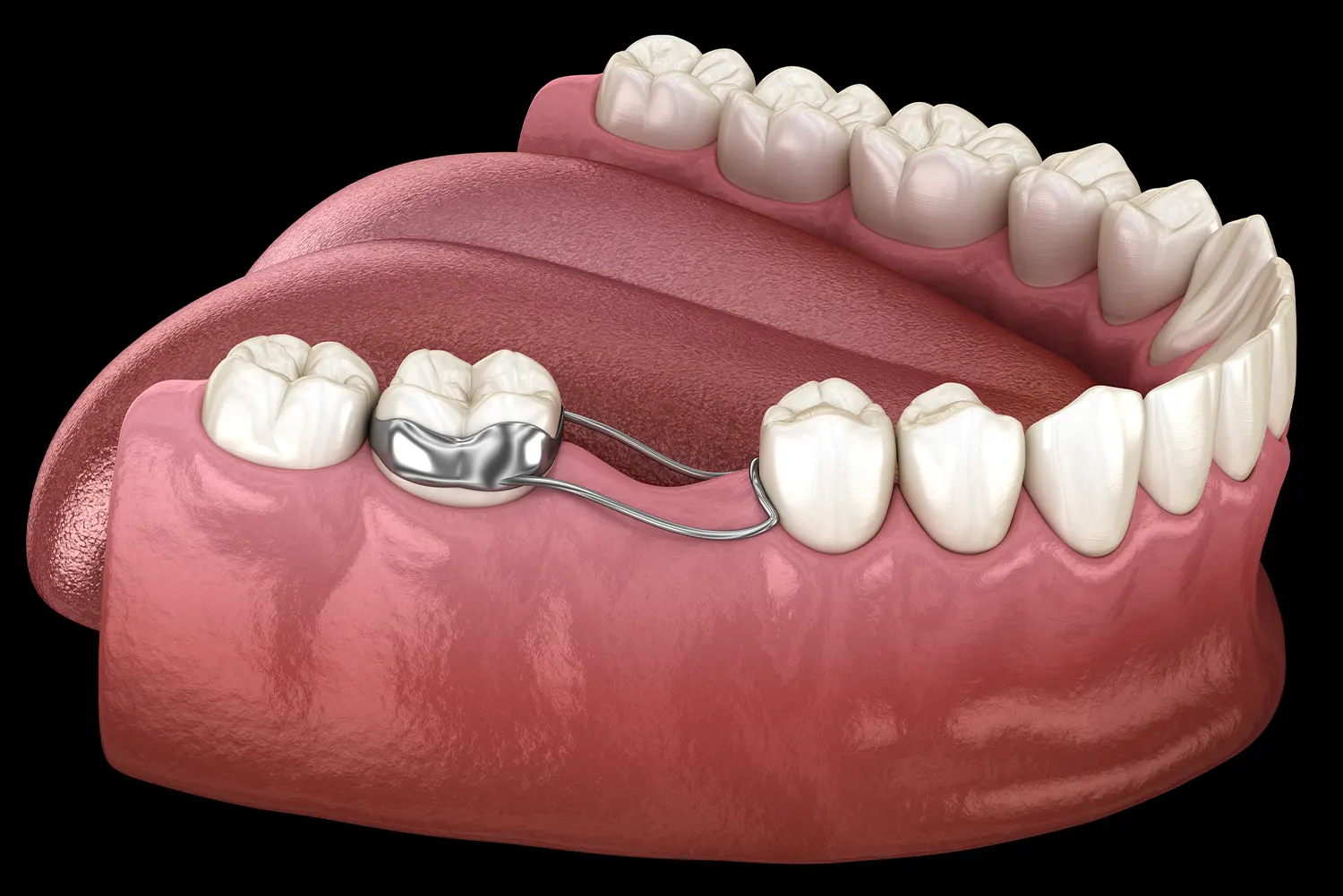 Why Space Maintainers Are Essential After Losing a Baby Tooth Early