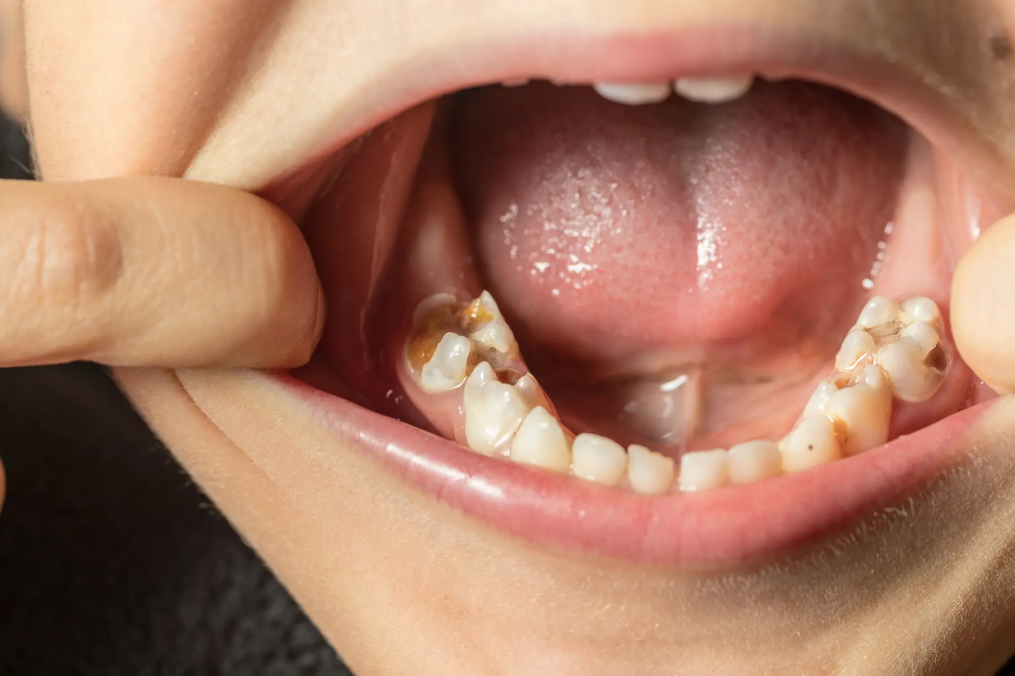 Healthy Snacks That Help Prevent Cavities for Kids