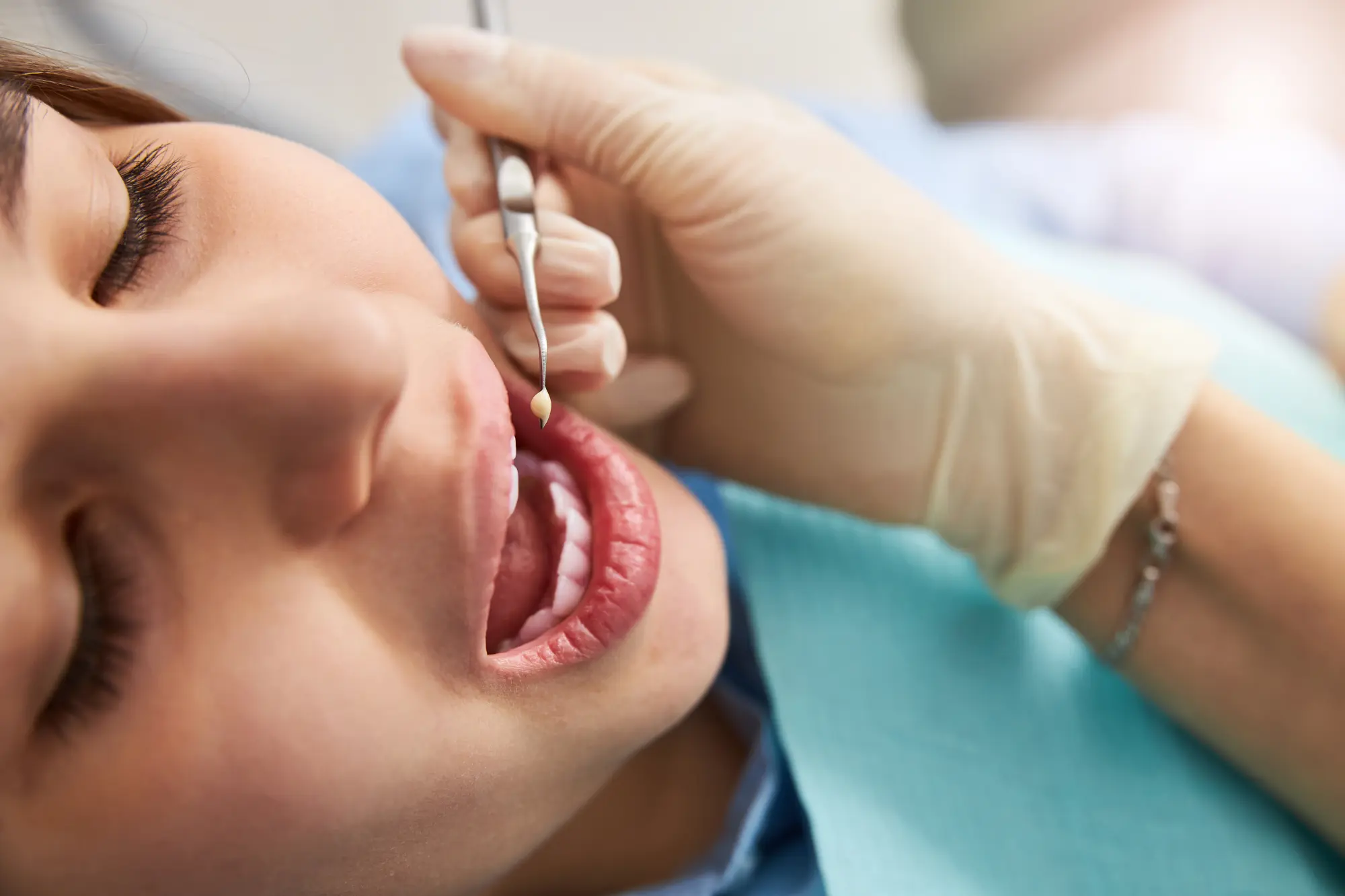 How Long Do Dental Fillings Last? Signs It's Time for a Replacement in Tacoma