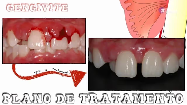 Tratamento das Doenças Periodontais