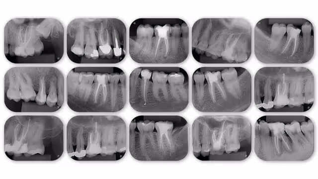 Endodontia Simples e Eficaz