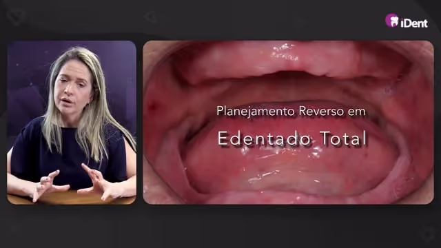 Imersão em Reabilitações Totais Fixas com Implantes