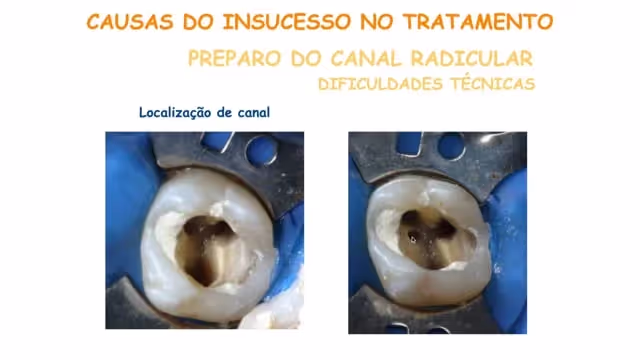 Retratamento Endodôntico