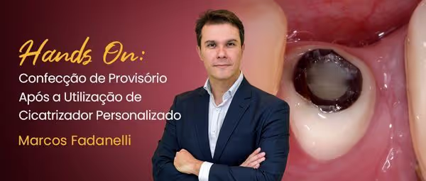 Hands On: Confecção de Provisório Após a Utilizaçāo de Cicatrizador Personalizado
