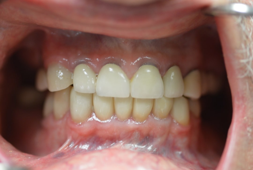 bob Lower teeth after