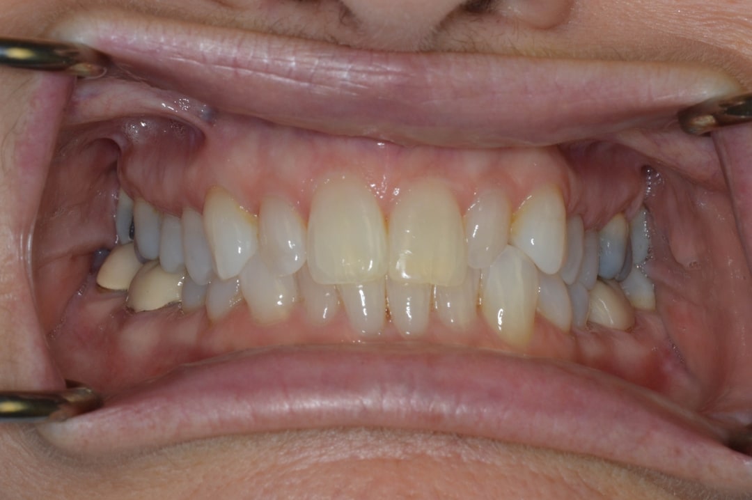 before and after treatment