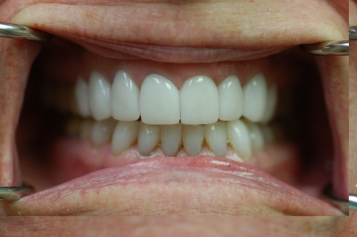 Pat Smile Makeover After