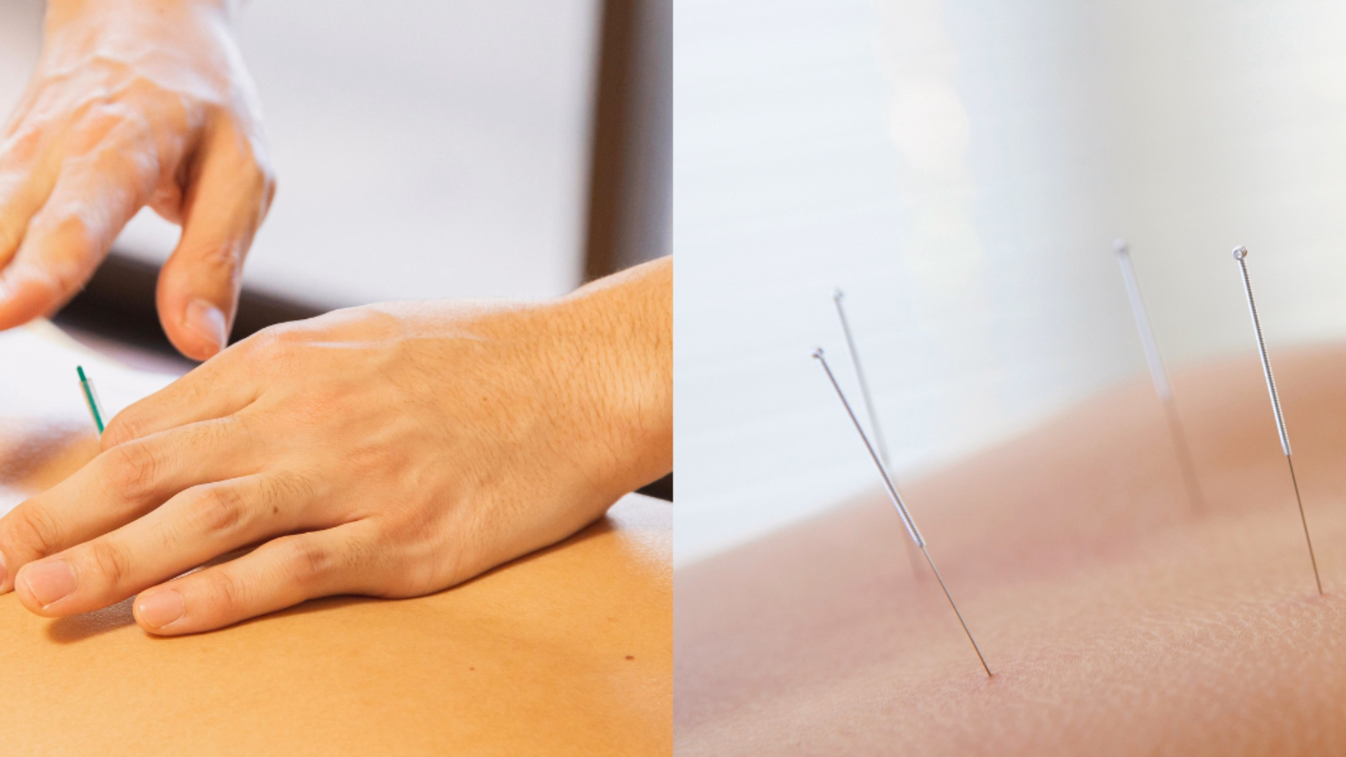 Dry Needling vs. Traditional Acupuncture: Understanding the Difference