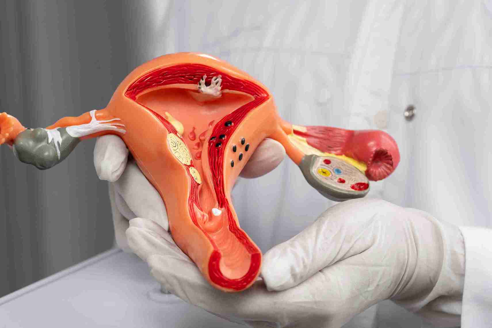 Why Do Some Fibroids Affect Fertility?