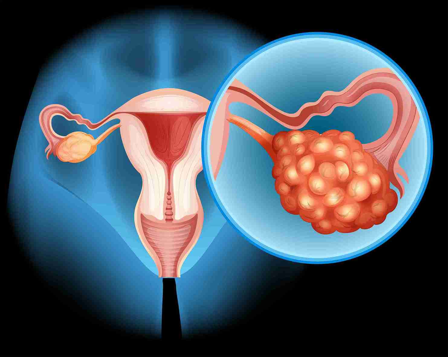 Ovarian hyperstimulation syndrome is an exaggerated reaction to the injectable hormones