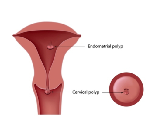 Endometrial polyp is a tissue growth arising