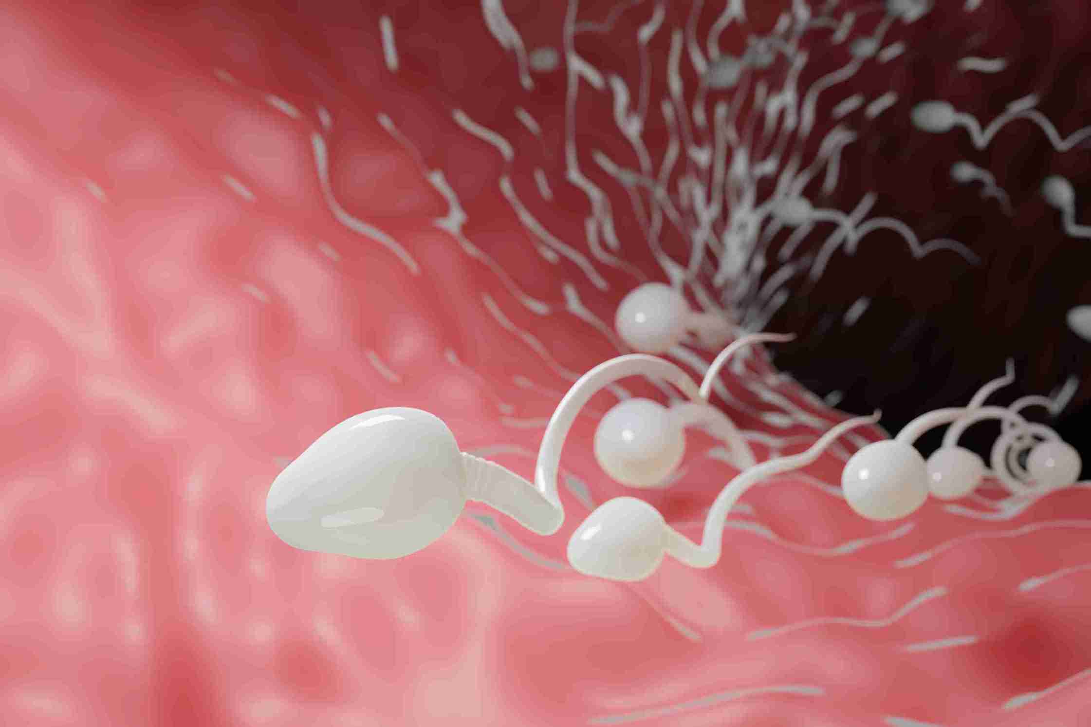 IUI helps sperm reach the egg inside the body