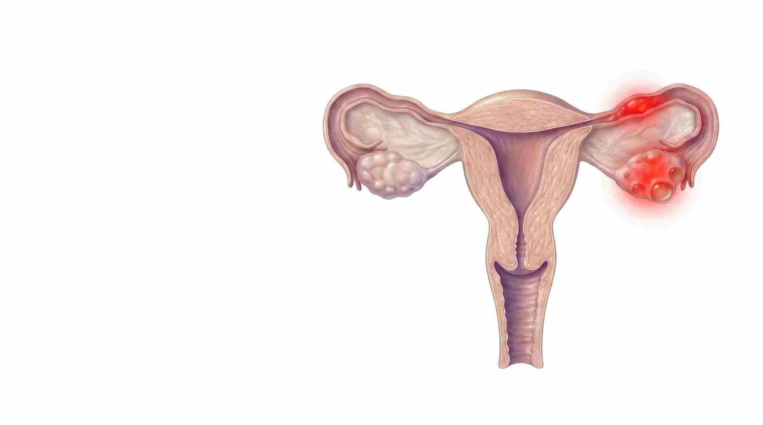 haemorrhagic cyst is self-limiting and resolves without intervention