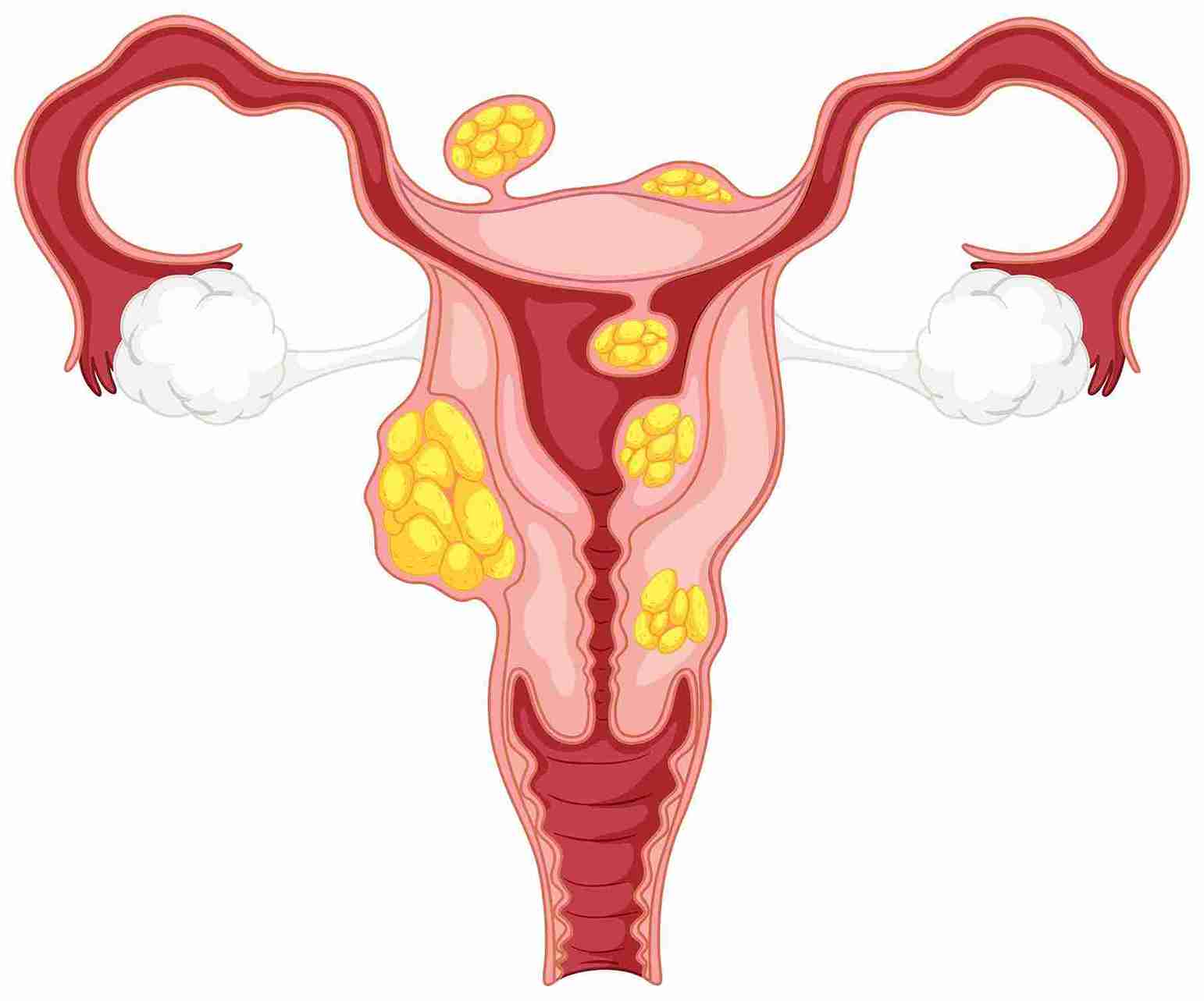haemorrhagic cysts resolve within 6 to 12 weeks