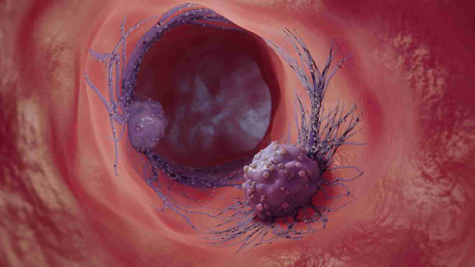 haemorrhagic ovarian cyst is benign and is not a sign of ovarian cancer