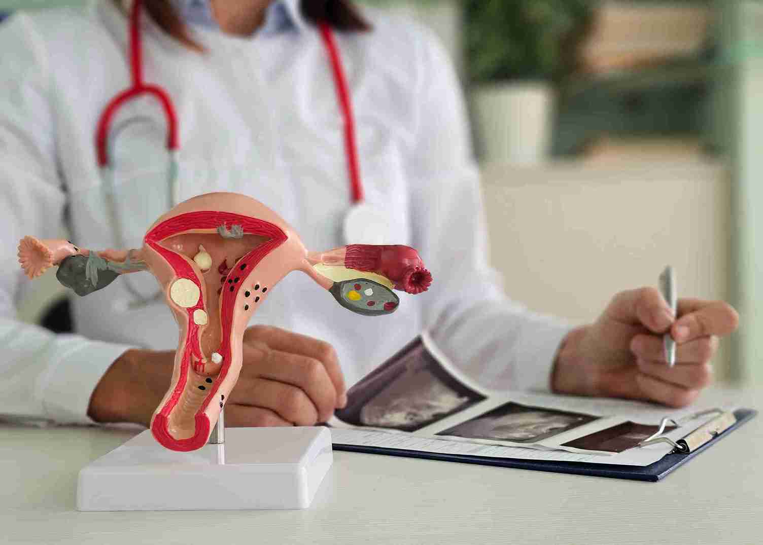 What is an ovarian cyst?
