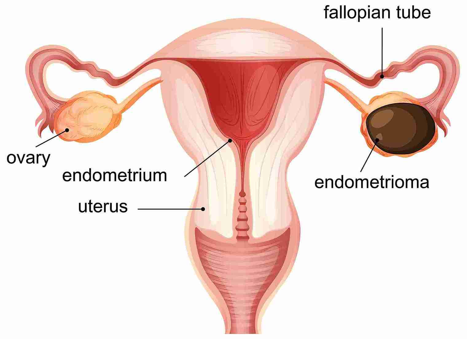 A chocolate cyst is a cyst that forms inside an ovary