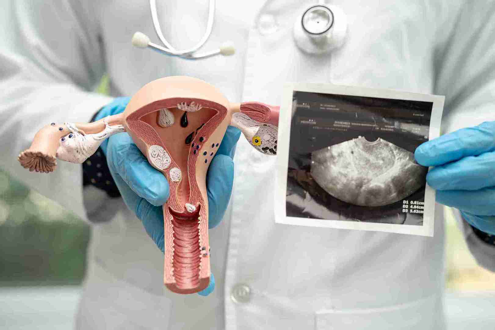 A cystadenoma is a growth