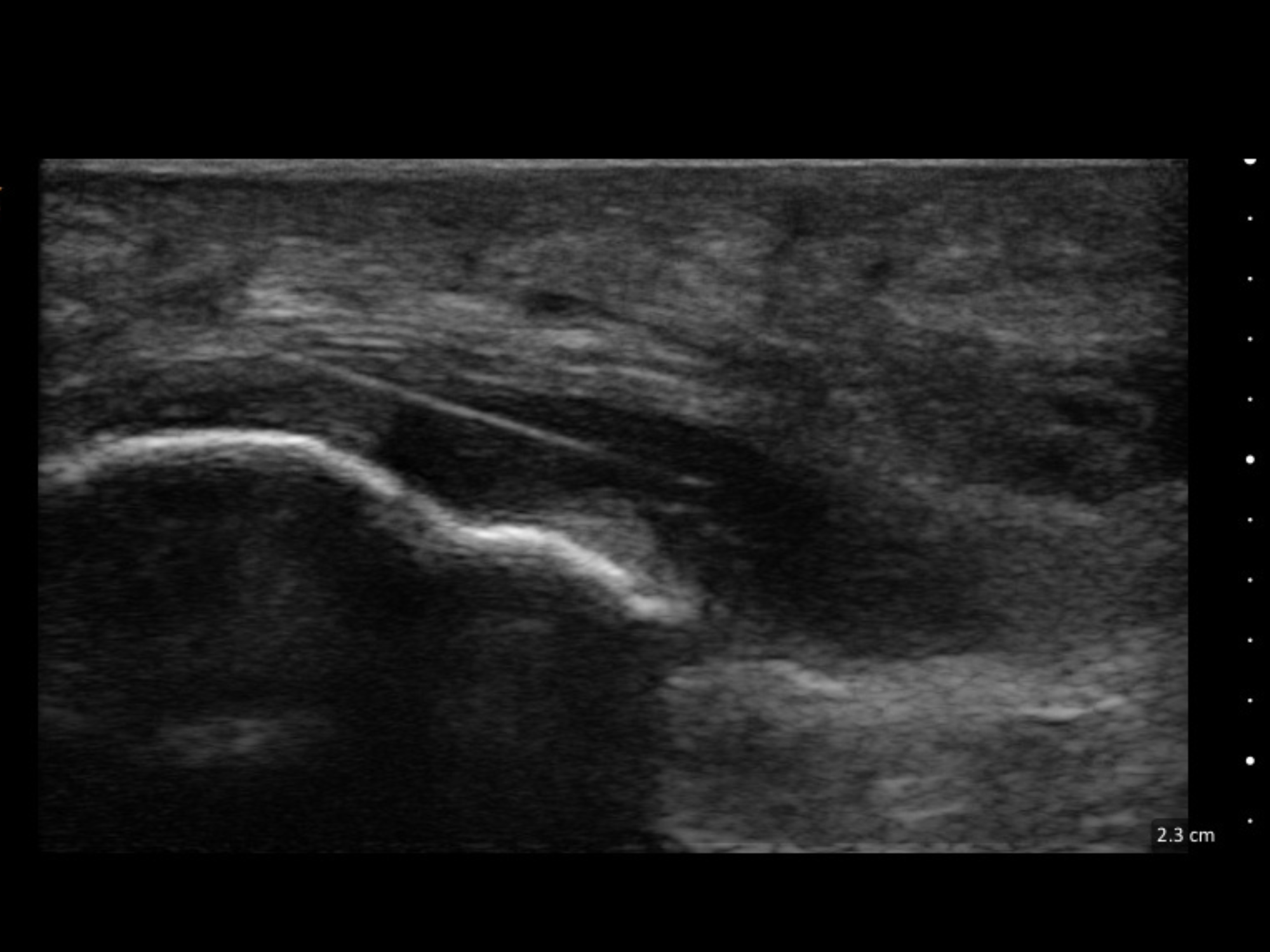 Ultrasound Guided Dry Needling