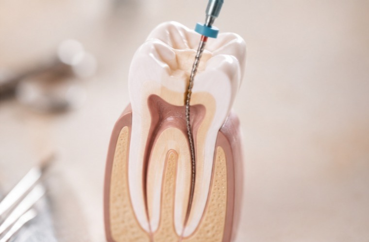 Does Your Child Need a Root Canal Treatment? Here's What Parents Should Know