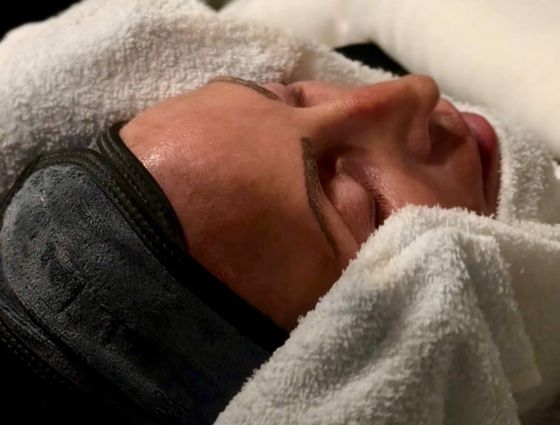 after-hydrafacial-treatment-medi-spa