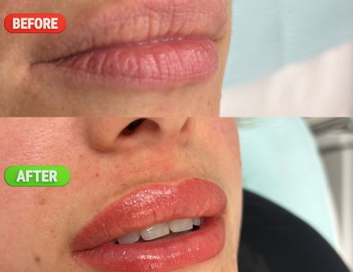 permanent-make-up-before-after
lip blushing