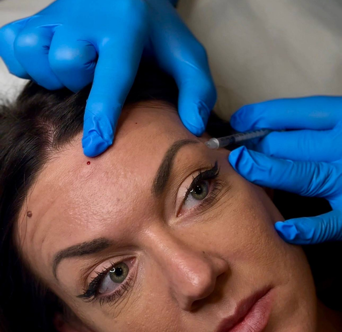 botox-facial-victoria