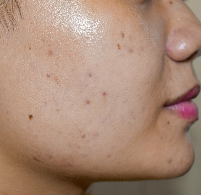lumecca-ipl-skin-concerns