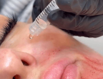 prp microneedling vs standard