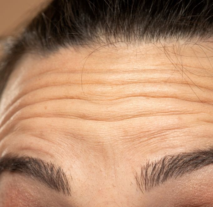 fine-lines-wrinkles