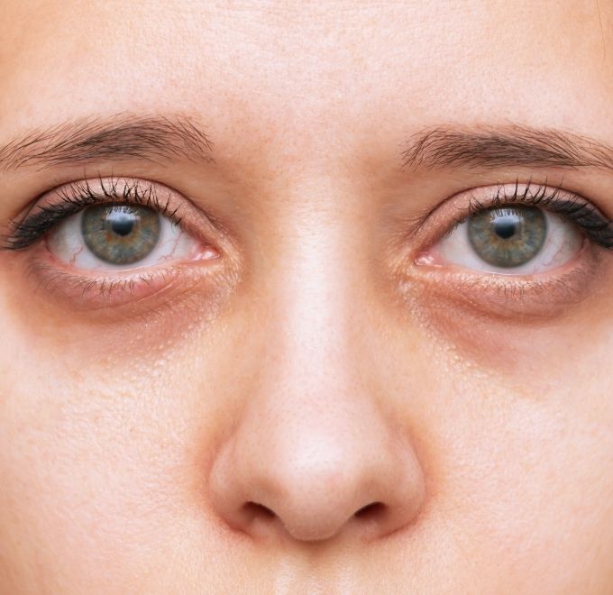dark-circles