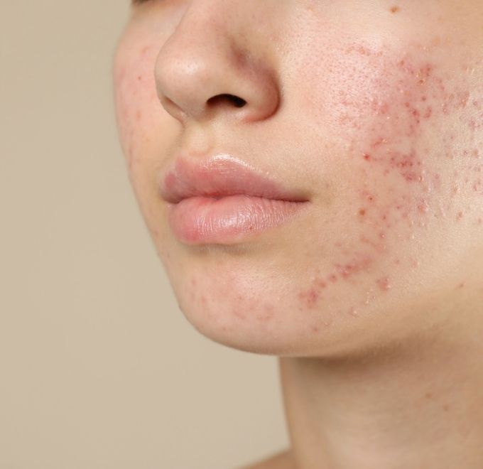 acne-acne-scars