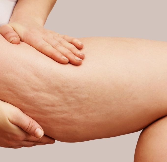 cellulite