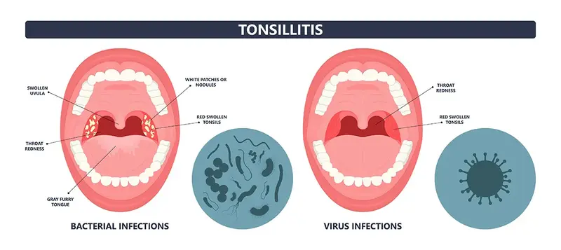 How Much Does Private Tonsil Removal? Tonsillectomy Pricing