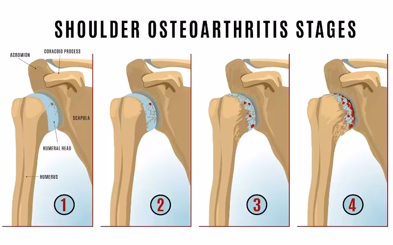 Diagram showing the stages of shoulder osteoarthritis