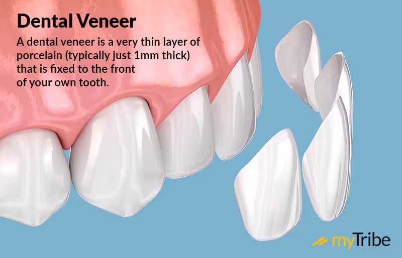 A Dental Veneer shown with texted explaining what it is.
