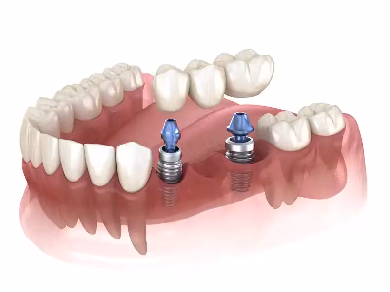 Implant supported bridge example