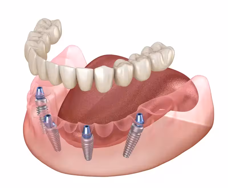 Diagram of all-on-four dental implants