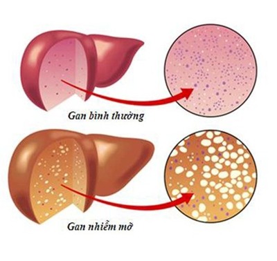 Căn bệnh viêm gan